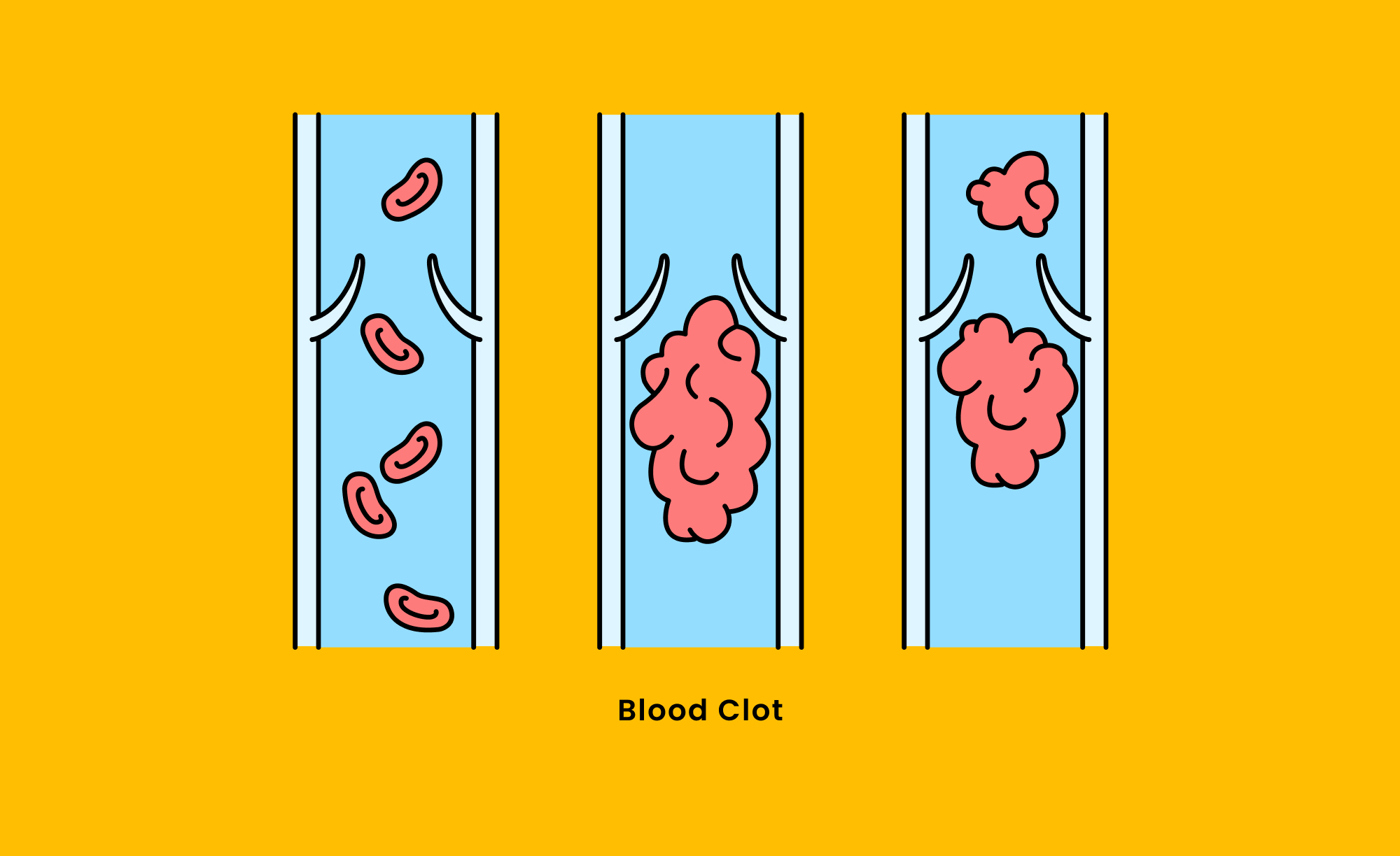 blood clot diagram