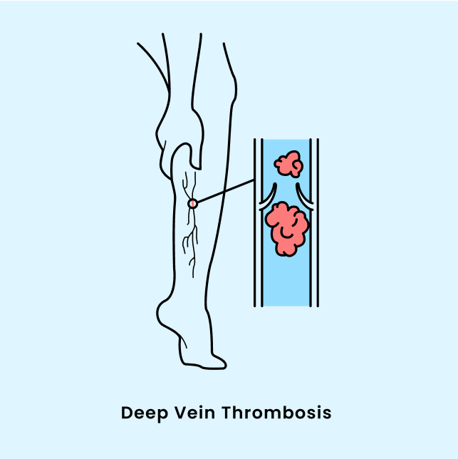 deep vein thrombosis diagram
