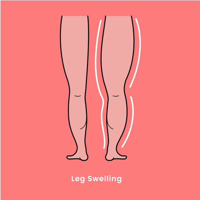 leg swelling diagram